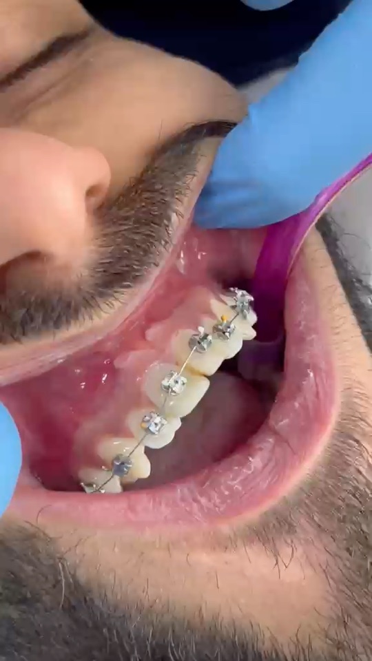 Ortodontik braket uygulaması